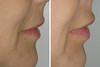 lip-implant-1-010 9