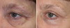 eyelid-surgery-5-003 2