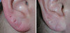 earlobe-repair-1-017 16