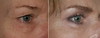 eyelid-surgery-6-001 10