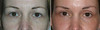 eyelid-surgery-3-001 18