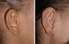 protruding-ears-1-051 14