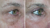 eyelid-surgery-2-110 2