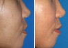 lip-implant-1-002 1