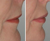 lip-implant-1-014 13