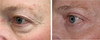 eyelid-surgery-1-015 14