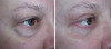 eyelid-surgery-1-040 0
