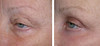 eyelid-surgery-3-042 14
