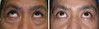 eyelid-surgery-6-011 2