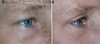 eyelid-surgery-2-073 1
