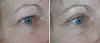 eyelid-surgery-2-102 3