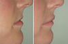 lip-implant-1-029 9