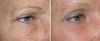 eyelid-surgery-3-047 1