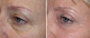 eyelid-surgery-5-040 1