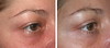eyelid-surgery-7-014 0