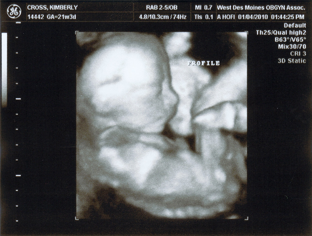 Беременность 21. Снимок УЗИ 21 неделя беременности.
