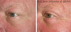 eyelid-surgery-2-055 13