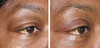 eyelid-surgery-2-034 11