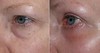 eyelid-surgery-4-030 1