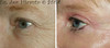 eyelid-surgery-2-060 18