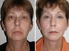 browlift-1-038 20
