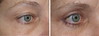eyelid-surgery-4-036 7