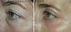 eyelid-surgery-2-049 7