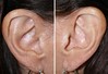 facelift-incisions-1-052 15