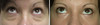 eyelid-surgery-2-074 13