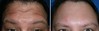 botox-forehead-wrinkles-1-002 1