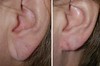 earlobe-reduction-1-005 4