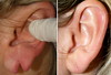 earlobe-repair-1-005 4