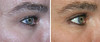 eyelid-surgery-1-071 12