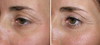 eyelid-surgery-5-015 14