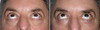 eyelid-surgery-6-014 4