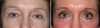 eyelid-surgery-6-020 10