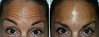 botox-forehead-wrinkles-1-004 3