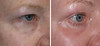 eyelid-surgery-1-021 1