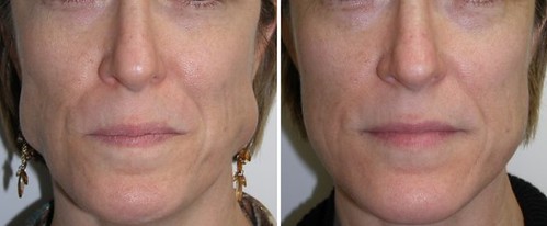 botox-masseter-muscle-1-002 | by lovethatface