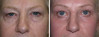 eyelid-surgery-1-020 0