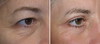 eyelid-surgery-5-048 9