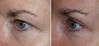 eyelid-surgery-7-033 15