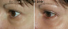 eyelid-surgery-2-075 3