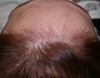 browlift-hairlines-1-005 4