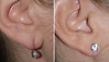 earlobe-repair-1-004 3
