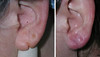 earlobe-repair-1-007 6