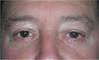 eyelid-surgery-2-042 0