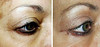 eyelid-surgery-2-013 13