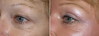 eyelid-surgery-6-047 18