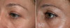 eyelid-surgery-7-005 6